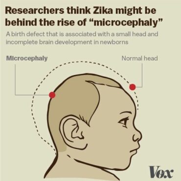 zikavirus og hjerneskade hos nyfødte